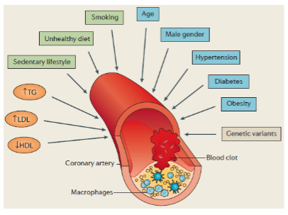 <p>CAD is caused by <strong>atherosclerosis</strong> (lipid deposition and inflammation) in blood vessels that supply the <strong>heart</strong>.</p><p>This can lead to <strong>myocardial infarction</strong> (MI) or <strong>heart attacks</strong>, a leading cause of death in the developed world.</p>