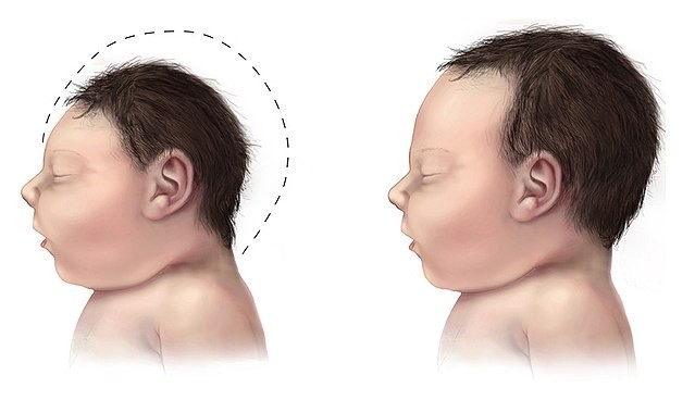 <p>HC3 standard deviations below the mean for age and the sex of the child</p><p>Can be congenital (genetic) or acquired (malnutrition, perinatal infection, anoxia)</p>