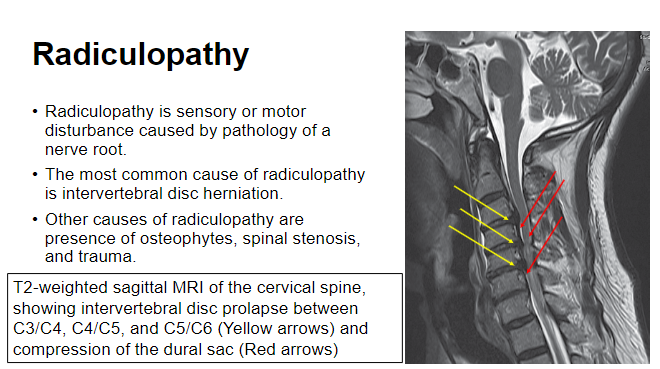 <p>A <strong>sensory or motor disturbance</strong> caused by pathology of a <strong>nerve root</strong>.</p>