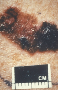 <p><strong>Melanoma</strong> is a type of <strong>skin cancer</strong> that can be <strong>thin</strong>, but still <strong>dangerous</strong> due to its <strong>rapid spread</strong>.</p><p><strong>UV irradiation</strong>, including both <strong>UVA and UVB</strong>, can cause <strong>melanoma</strong>, even in <strong>pigmented mice</strong>.</p><p>This information is <strong>relevant to sunscreen design</strong> and <strong>tanning salons</strong>, as both types of UV radiation contribute to the risk of developing melanoma.</p>