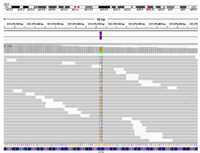 <p><strong>Exome Sequencing</strong>: The patient’s DNA sample is subjected to exome sequencing to capture and analyze the protein-coding regions.</p><p><strong>Consensus Sequence</strong>: After sequencing, a consensus sequence is generated, representing the most likely sequence of the patient’s exomes.</p><p><strong>Mutation Identification</strong>: The sequencing results are analyzed to identify any mutations or genetic variations, such as a heterozygous mutation in a gene like CFTR.</p>