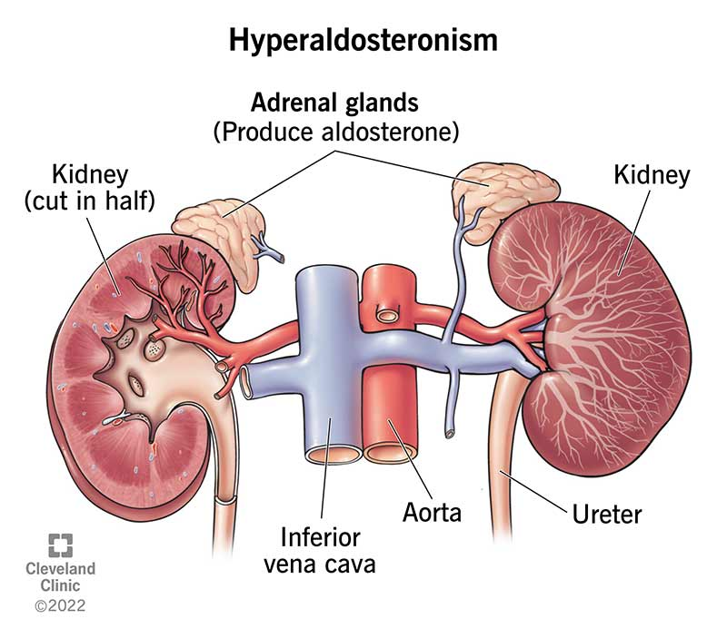 <p><u>Conn's syndrome is:</u></p><p>❀ Primary hyperaldosteronism.</p>