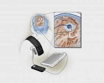 <p>adaptive Deep Brain Stimulation</p><p>more invasive</p><p>signals to the brain/from the brain</p><p></p><p><em>The procedure involves implanting electrodes in the brain to deliver electrical stimulation using an implanted battery source called an impulse generator. It uses feedback from the brain itself to fine-tune its signaling.</em></p>