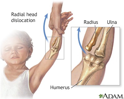 <p>occurs when radius slips out of place from where it normally attaches to the elbow joint</p><p>-immediate pain</p><p>-refusal or inability to move arm</p>