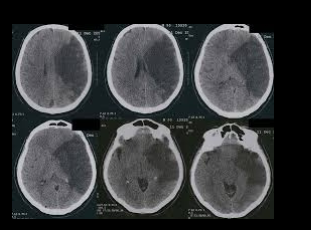 <p><strong>Middle cerebral artery infarction</strong>: A blockage in the middle cerebral artery can lead to Broca's aphasia.</p><p><strong>Haemorrhagic stroke</strong>: Bleeding in the brain, which can affect the same areas involved in speech production.</p>