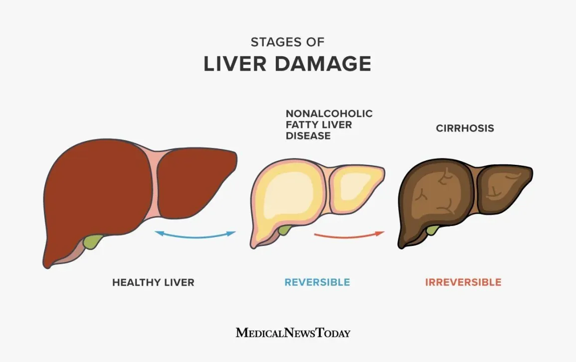 <p>✩ Stage 1: <span class="tt-bg-yellow">Fatty liver</span>, characterized by the accumulation of fat in liver cells</p><p>✩ Stage 2: <span class="tt-bg-blue">Alcoholic hepatitis</span>, involving inflammation caused by the death of groups of liver cells</p><p>✩ Stage 3: <span class="tt-bg-red">Cirrhosis</span>, which includes fibrosis, scarring, and further cell death</p>