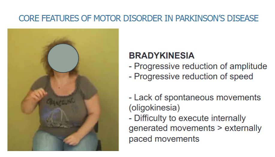 <p><strong>Bradykinesia:</strong></p><p>Progressive reduction of amplitude</p><p>Progressive reduction of speed</p><p>Lack of spontaneous movements (oligokinesia)</p><p>Difficulty executing internally generated movements</p><p>Difficulty with externally paced movements</p>