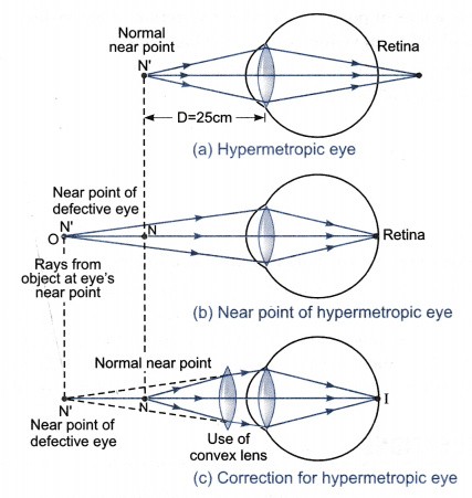 <p><strong>hyperopia</strong></p><p></p><p>converging</p>