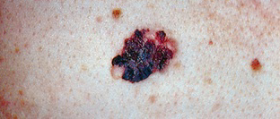 Transformation of melanocytes may arise from preexisting nevus or de novo. Usually brown; can be tan, black, pink-red, purple, or
mixed pigmentation. Often irregular or notched borders. May have scaling, flaking, oozing texture. Risk factors are UV radiation from sun exposure
and indoor tanning, aging, and family history. In men, most melanomas are located on the trunk and back; in women most are on the legs and feet;
in older adults, most are on the head and neck. 
