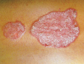 A hereditary chronic inflammatory skin disease with
environmental triggers. Raised
scaly, erythematous patch, with silvery scales, often
pruritic and painful. Occurs on scalp, extensor surfaces
of knees and elbows, lower back. Accompanied by
nail pitting, onycholysis 
