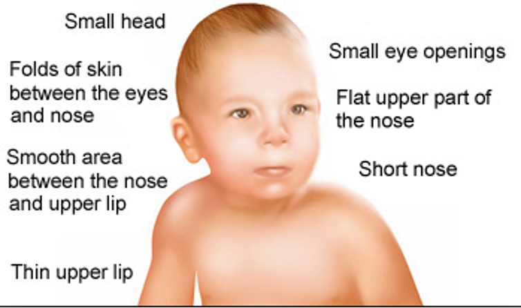 <p>–<em>Delay in oral feeding development</em></p><p>–<em>Central nervous system (CNS) dysfunctions most common</em></p><p>–<em>Impulsivity, cognitive impairment, speech and language abnormalities</em></p><p>–<em>Learning disabilities indicative of CNS involvement</em></p>