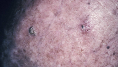 <p><strong>Solar keratoses</strong> (also known as <strong>actinic keratoses</strong>) are <strong>dysplastic growths</strong> of <strong>keratinocytes</strong> that result from <strong>UV irradiation</strong>.</p><p>They are often considered <strong>precancerous lesions</strong> that can potentially develop into <strong>skin cancer</strong> if left untreated.</p>