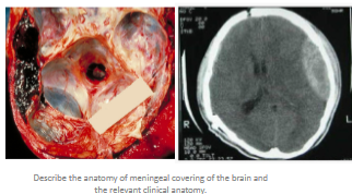 <p>The <strong>dura mater</strong> is sensitive to <strong>stretching</strong>, which forms the anatomical basis for <strong>headaches</strong>.</p><p><strong>Damage to the middle meningeal artery</strong> can lead to an <strong>extradural (epidural) hematoma</strong>.</p>