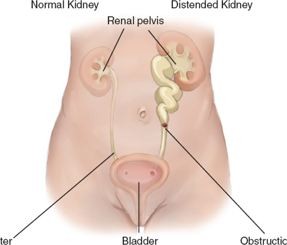 <p><strong>Hydronephrosis</strong></p>