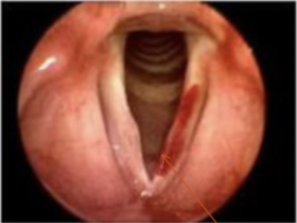 <p>Hemorrhage:• A rupture of the blood vessels results in bleeding into the submucosal layer. • Reddened, edematous vocal fold appearance, usually unilateral may be bilateral.Etiology: • May result from a single episode of traumatic voice use or laryngeal trauma or a combination of heavy voice use and use of anticoagulants, and extended use of inhaled steroids.</p>