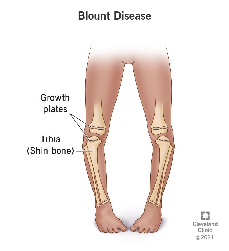 <p>normal physiologic bowing or gene vacuum becomes more pronounced in the child with tibia vara</p><p>-occurs in early walkers, associated with obesity</p><p>-If left untreated, growth plate of upper tibia ceases bone production</p><p>-assymetric growth at knee </p>