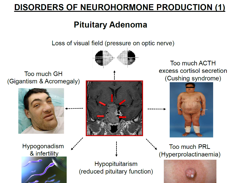 <p><strong>Loss of visual field</strong>: Pressure from the adenoma on the optic nerve can cause loss of vision.</p><p><strong>Hormone imbalances</strong>: Pituitary adenomas can cause excessive secretion of hormones such as ACTH, GH, or PRL.</p>