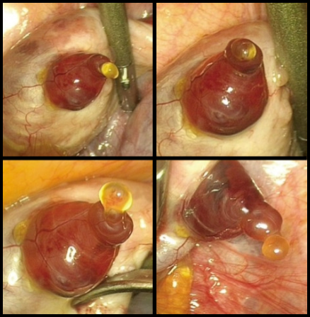 <p><strong>Basement Membrane Breakdown</strong>: <span class="tt-bg-yellow">The basement membrane of the follicle breaks down,</span> causing blood to flow into the middle of the follicle.</p><p><strong>Extrusion of Oocyte Cumulus Complex</strong>: The oocyte <span class="tt-bg-red">cumulus complex is extruded and caught by the fimbriae</span> of the uterine tube (fallopian tube).</p>