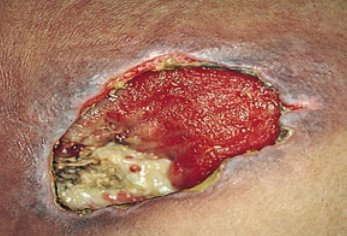 Wound involves all skin layers and extends into supporting tissue. Exposed muscle, tendon, or bone, and may show slough (stringy matter attached to wound bed) or eschar (black or brown necrotic tissue), tunneling 

