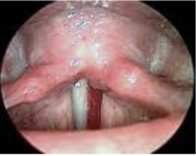 <p>Hemorrhage Characteristics:◦Perceptual –hoarseness, loss of upper range, vocal fatigue, dryness. Patients may complain of pain particularly at the time of the vocal injury.◦Acoustic –no known data</p>