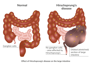 <p>In Hirschsprung's disease, there is a lack of enteric ganglia in the affected segment of the colon, leading to abnormal peristalsis and tone.</p>
