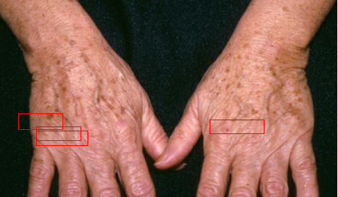 Small, flat, brown macules. Circumscribed areas contain clusters of melanocytes that appear after extensive sun exposure. Appear on the forearms or dorsa of hands. 
