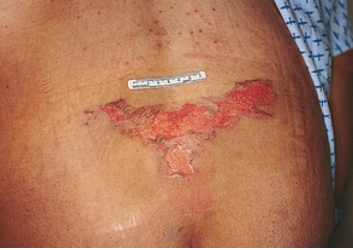 Loss of epidermis and exposed dermis. Superficial ulcer looks shallow like an abrasion or open blister with a red-pink wound bed. No visible or deeper tissue
