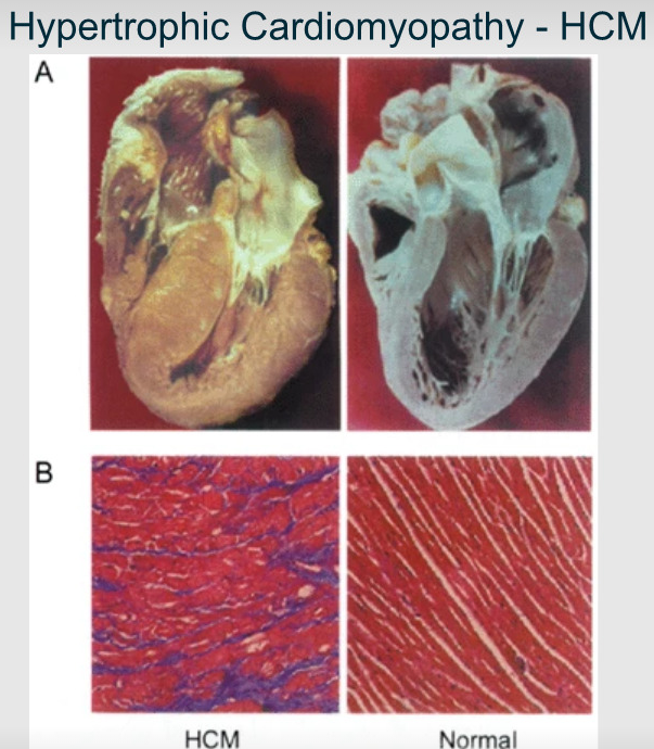<p>Is a genetic heart condition where the heart muscle becomes abnormally thick (hypertrophied), making it harder for the heart to pump blood effectively</p>