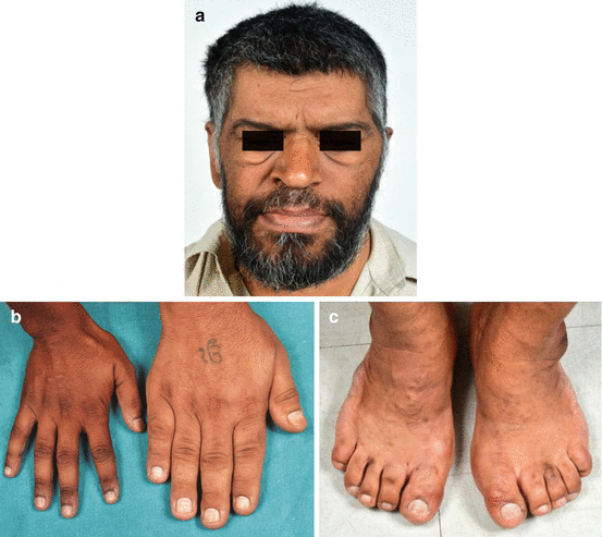 <p>Acral enlargement can lead to spade-like hands, rings becoming too small, increased shoe size, macroglossia (enlarged tongue), and carpal tunnel syndrome in individuals with GH/IGF-I excess.</p>
