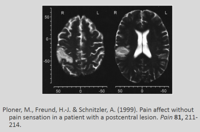 <p>The <strong>lateral pain system</strong> is responsible for the sensory-discriminative aspect, allowing the brain to recognize the location, intensity, and type of pain.</p><p>The <strong>medial pain system</strong> is responsible for the affective-motivational aspect, influencing the emotional response and motivation related to pain.</p>