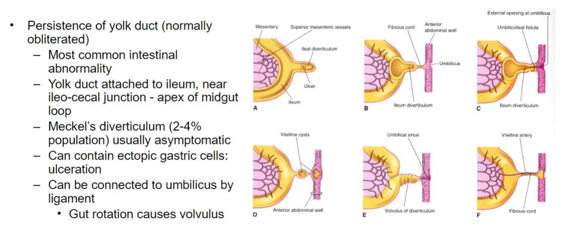 <p>Meckel's diverticulum can contain ectopic gastric cells, leading to ulceration. Additionally, it can be connected to the umbilicus by a ligament.</p>