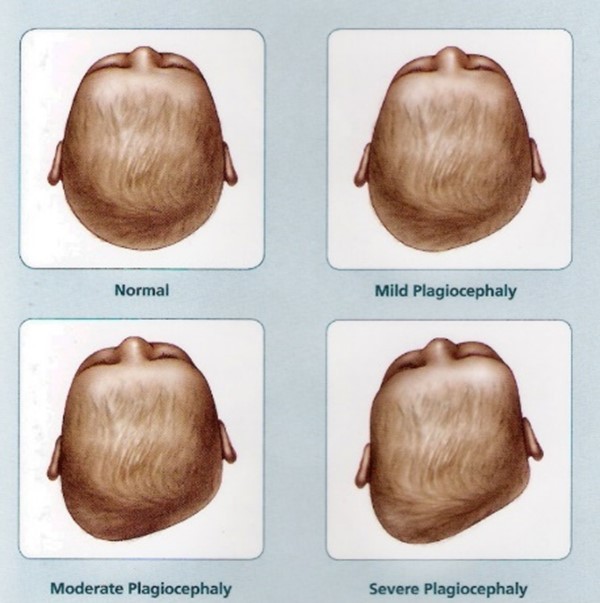 <p>Asymmetry of head without fused sutures</p>