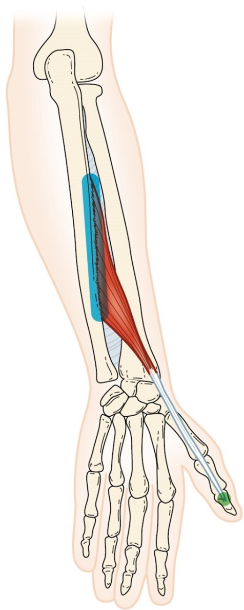 <p>Extensor Pollicis Longus</p>