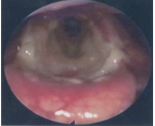 <p>Laryngeal Burns: Etiology: ◦ Thermal (caused by inhalation of hot air or gases)◦ Chemical (caused of ingestion of corrosive chemicals)Characteristics:◦ Perceptual –hoarseness, may have pain during phonation◦ Characteristics may vary depending on type of burn◦ Acoustic ◦ no known data</p>