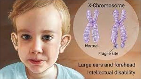 <p>•<strong>Most common inherited cause of intellectual disability; can affect males and&nbsp;females but females typically have milder symptoms</strong>​</p><p>•Minor dysmorphic features​</p><p>•Developmental delay/Intellectual impairment​</p><p>•Behavior problems:​</p><p>•Attention deficits​</p><p>•Hand flapping and biting​</p><p>•Hyperactivity​</p><p>•Shyness and social isolation​</p><p>•Low self-esteem​</p><p>•Gaze aversion​</p>