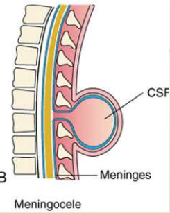 <p>What is <strong>meningocele</strong>?</p>