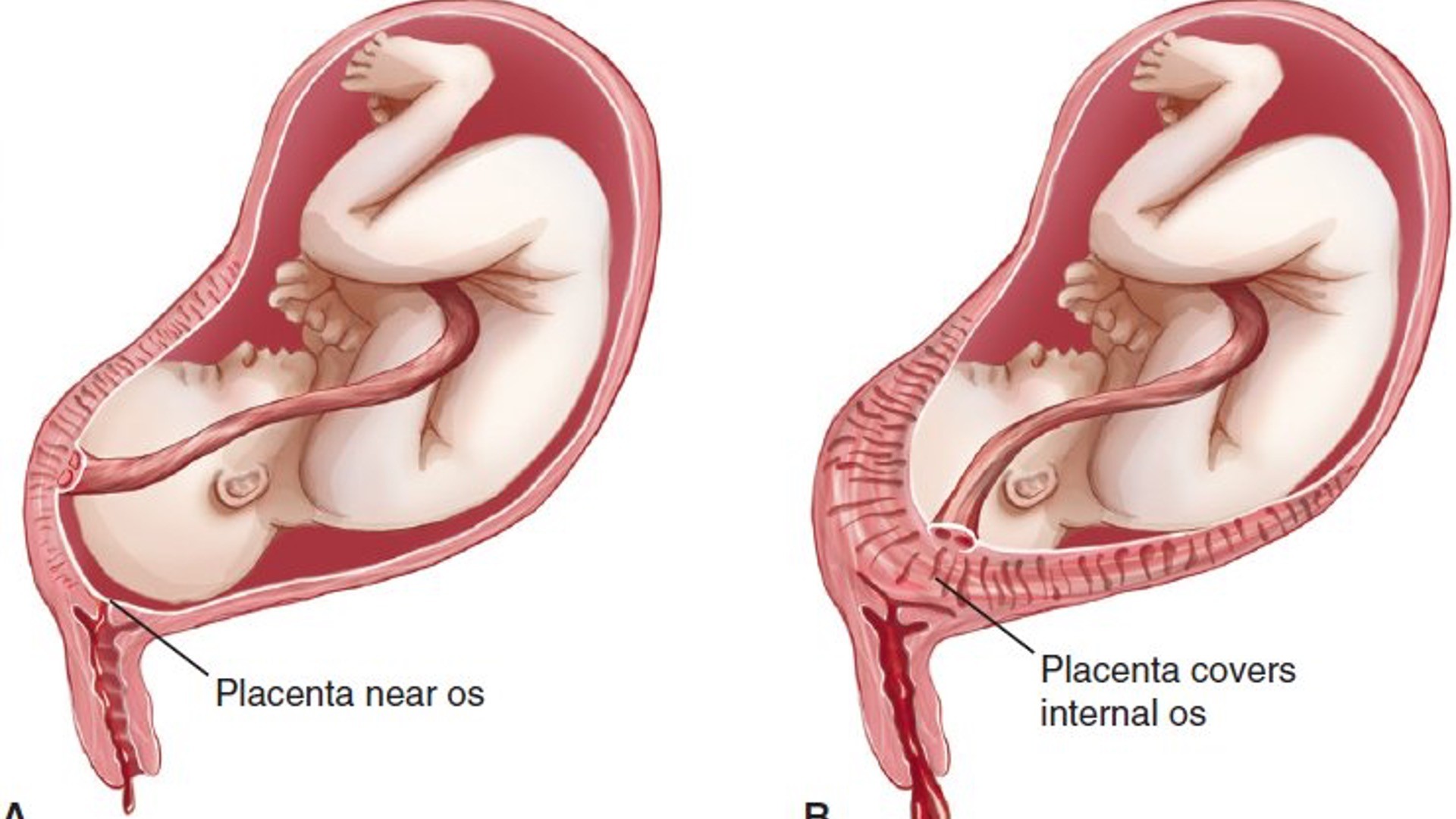 <p>•Placenta implantation in the lower uterine segment</p><p>Predisposing Factors:</p><p>•Prior uterine scar</p><p>•Multiple pregnancies/gestation</p><p>•Prior history of placenta previa</p><p><u>Symptoms</u></p><p>•<strong><em><span class="tt-bg-red">Painless, quiet onset bright red bleeding</span></em></strong></p><p>•Bleeding may be intermittent or continuous</p><p><strong><em><span class="tt-bg-red">•Uterus soft, palpable</span></em></strong></p><p>•Presenting part is high and <strong><em><span class="tt-bg-red">deviated to one side</span></em></strong></p><p>•Associated with<strong><em><span class="tt-bg-red"> preeclampsia&nbsp;</span></em></strong></p>