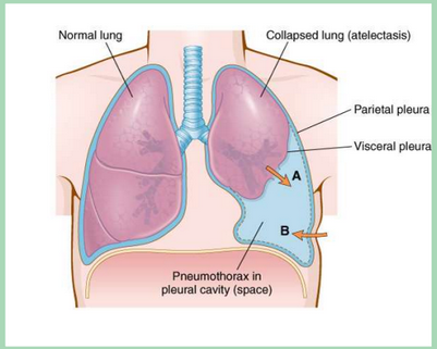 <p>collection of air in the pleura space.</p>