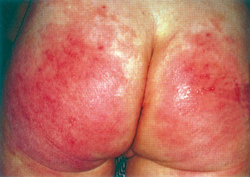 Red, moist, maculopapular patch with poorly defined borders in diaper area, extending along inguinal and gluteal folds. History of infrequent diaper changes or occlusive coverings. Inflammatory disease caused by skin irritation from ammonia, heat, moisture, occlusive diapers
