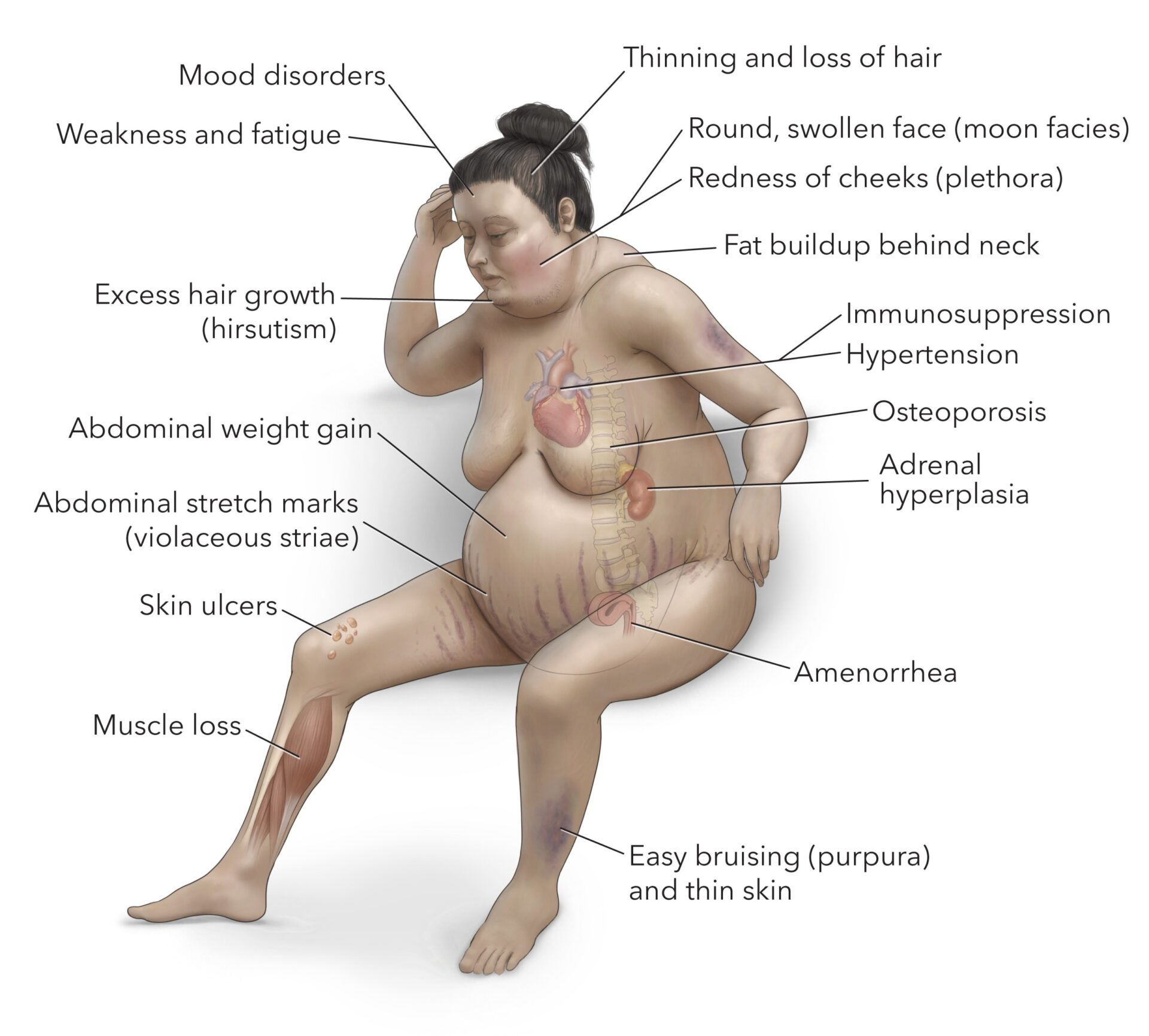 <p>♥︎Cushing's syndrome is a hormonal disorder caused by prolonged exposure to high levels of cortisol hormone in the body.</p>