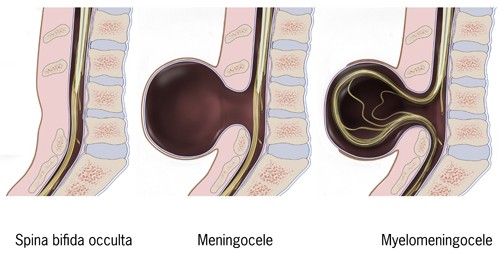 <p><strong>spina bifida cystica</strong>- meningocele and myelomeningocele</p><p><strong>Meningocele</strong>- meninges herniate through a defect in the vertebrae</p><p>visible external sac protruding from spinal area: care to prevent rupture of sac</p><p>Treatment included surgical correction of lesion</p><p><strong>Myelomeningocele-</strong> most severe </p><p>spinal cord often ends at the point of defect, resulting in absent motor and sensory function </p><p>long term complications pf paralysis, orthopedic deformities, and bladder and bowel incontinence</p><p>accompanying hydrocephalus </p>