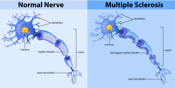 <p>In MS, a <strong>leaky blood-brain barrier</strong> allows <strong>immune cells</strong> to cross into the <strong>central nervous system (CNS)</strong> and attack the myelin.</p><p>This results in <strong>inflammation</strong> and the formation of <strong>sclerotic lesions</strong> (scars) on nerve fibers.</p>