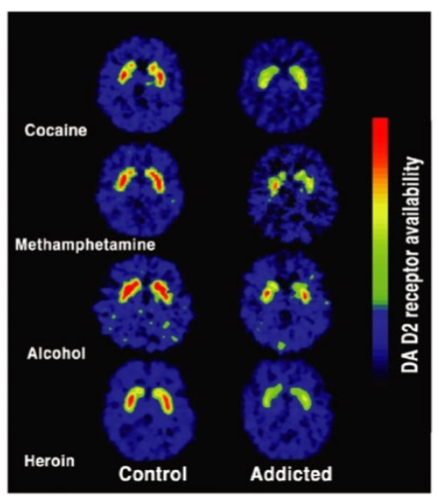 <p><strong>D2 receptors</strong> are involved in the brain's <strong>reward system</strong> and influence motivation and pleasure.</p><p><strong>Reduced D2 receptor availability</strong> in drug abusers is linked to <strong>impaired reward processing</strong>, leading to a diminished ability to experience pleasure from natural rewards.</p><p>This reduction in D2 receptor activity may <strong>increase vulnerability</strong> to substance abuse, as individuals may seek drugs to compensate for the lack of natural reward response.</p>