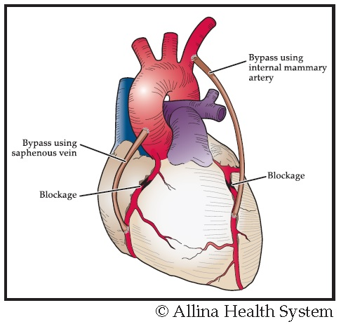 <p><strong>A surgical procedure used to treat coronary heart disease</strong>. It diverts blood around narrowed or clogged parts of the major arteries to improve blood flow and oxygen supply to the heart</p>