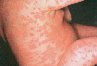 Red-purple maculopapular blotchy rash in dark skin and light skin appears on 3rd or 4th day of illness. Rash appears first behind
ears and spreads over face and then over neck, trunk, arms, and legs; looks “coppery” and does not blanch. Also characterized by Koplik spots in
mouth—bluish white, red-based elevations of 1 to 3 mm. Vaccine refusal has caused a decline in herd immunity and numerous outbreaks of infectious diseases.
