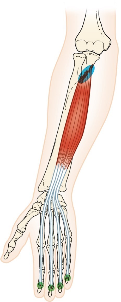 <p>Flexor Digitorum Profundus</p>