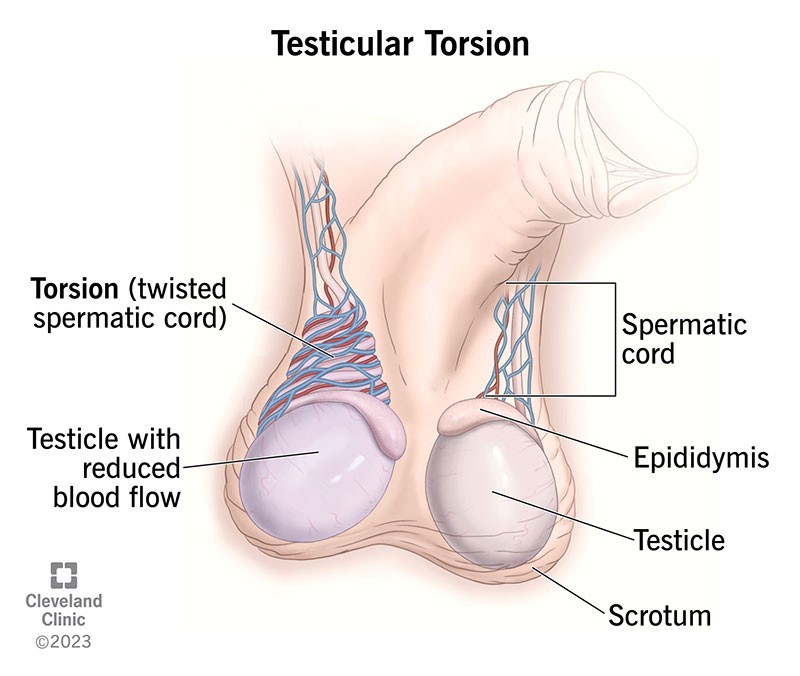 <p>abnormally attached to the scrotum and twisted, <strong>medical emergency</strong></p><p>•Sudden, severe pain on one side of the scrotum</p><p>•Requires <strong>immediate surgery</strong> because ischemia can result if the torsion is left untreated, leading to infertility</p><p>(during puberty)</p>