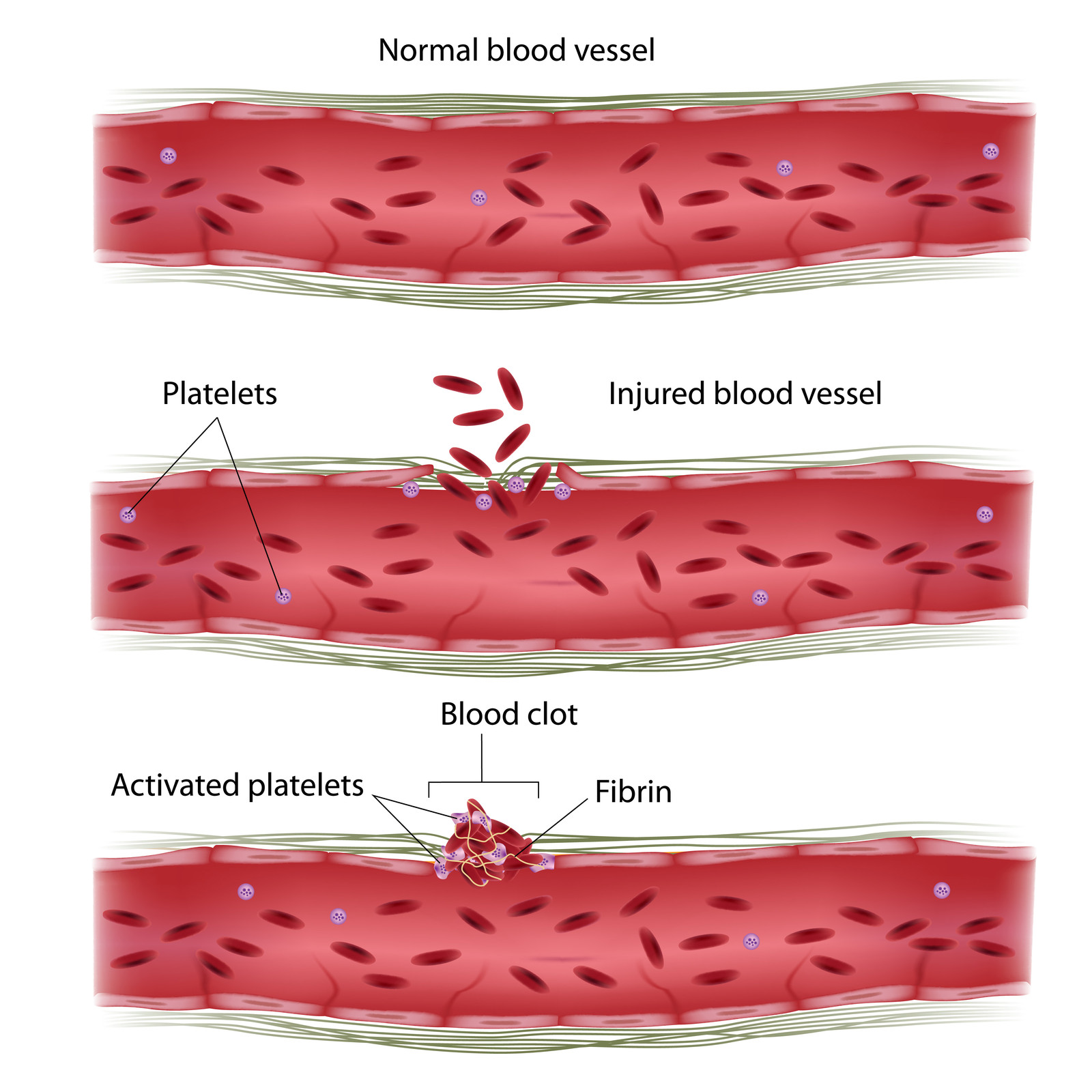 <p>The vessel wall will vasoconstrict (spasm) immediately after, to slow the blood flow to the area of injury (avoids excess blood loss)</p><p></p><p>+Reduced blood flow allows contact activation of platelets and coagulation factors</p>