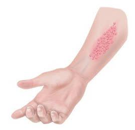 Clusters of lesions (e.g., vesicles of contact
dermatitis).
