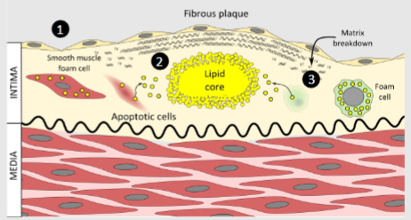 <p>1)</p><p>-Smooth muscle cells accumulate LDL becoming a second type of foam cell, but they continue to make extracellular matrix of elastin and collagen which forms a fibrous plaque</p><p>2)</p><p>-Cells underneath this plaque become oxygen starved they begin to undergo apoptosis and release their fat which forms a globule of fat that is now accumulating in the intima, known as the lipid core</p><p>3)</p><p>-The dying cells release matrix metalloproteases and other enzymes which can break down the fibrous matrix towards the edge of the plaque leaving a large lipid core covered by a thinner fibrous plaque.</p>